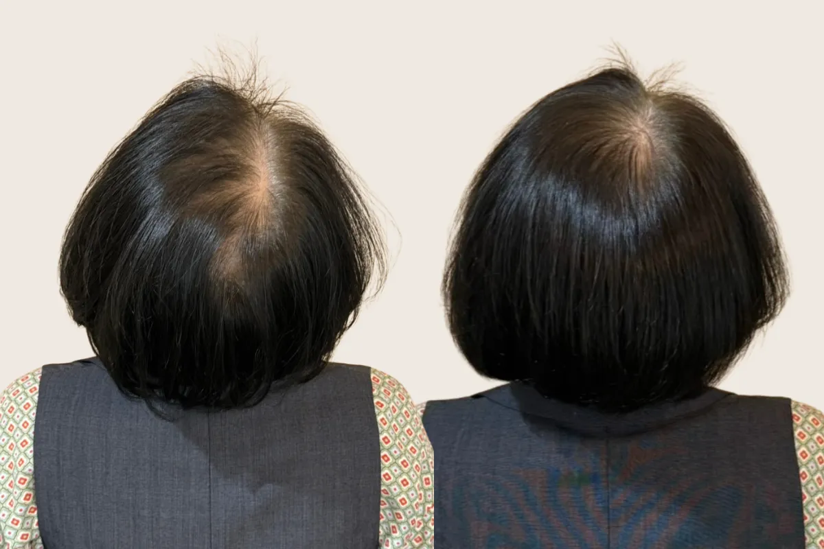 600本施術→500本